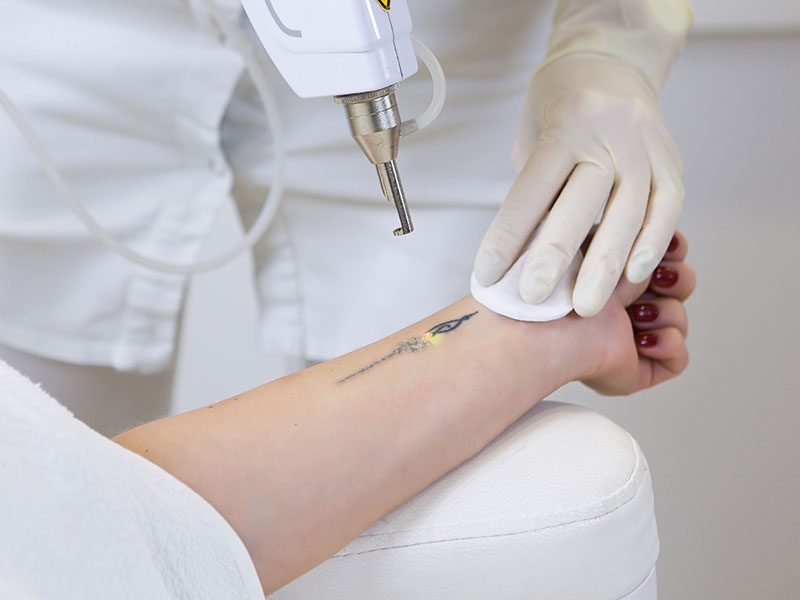 laserove-odstranenie-tetovania