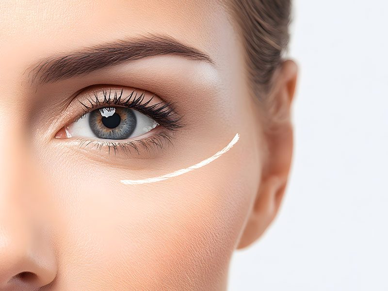 lifting-ocneho-okolia2